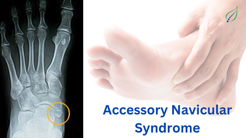 Accessory Navicular Syndrome