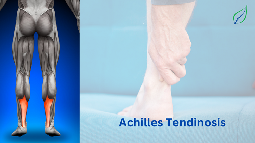 Achilles Tendinosis