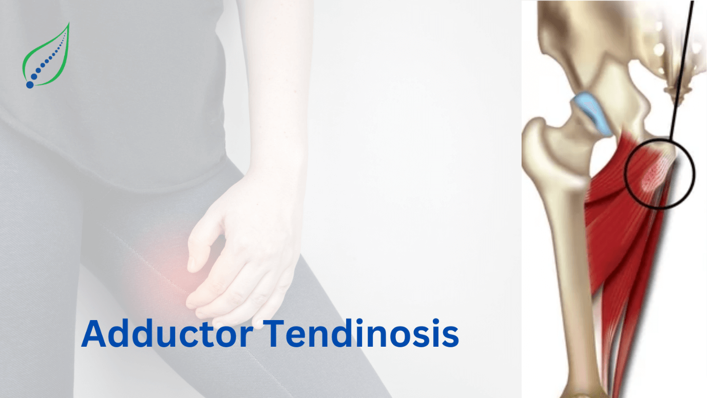 Adductor Tendinosis