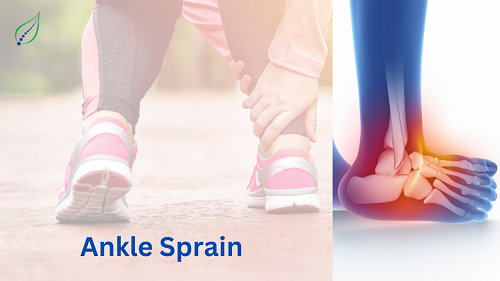 ankle-sprain