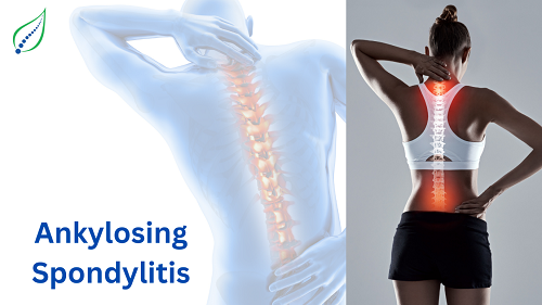 ankylosing-spondylitis