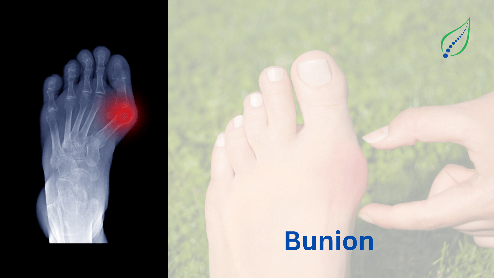 Bunion