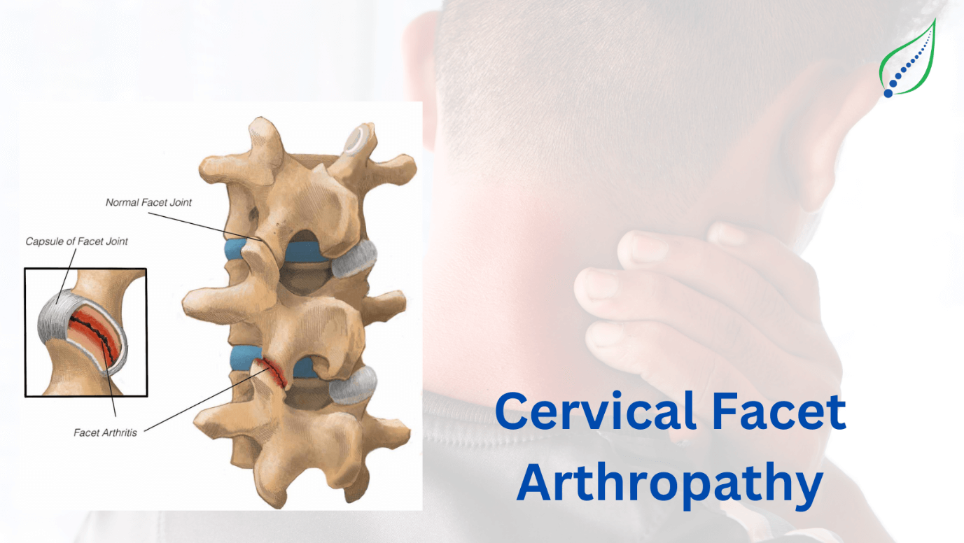 cervical-facet-arthropathy