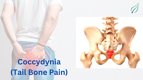 coccydynia