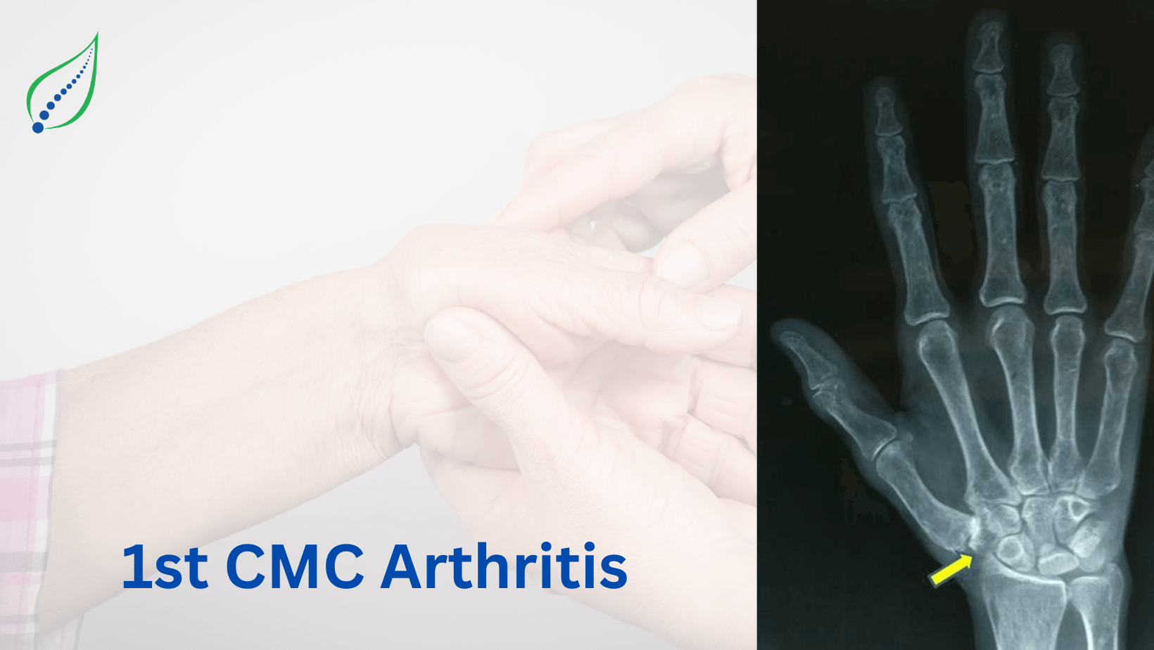 1st CMC Arthritis