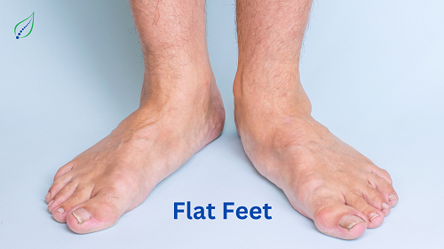 flat-feet