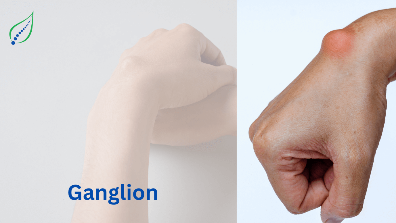 Ganglion