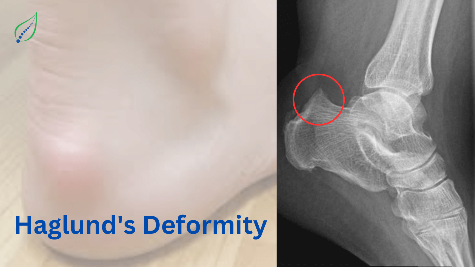 Hagunds Deformity