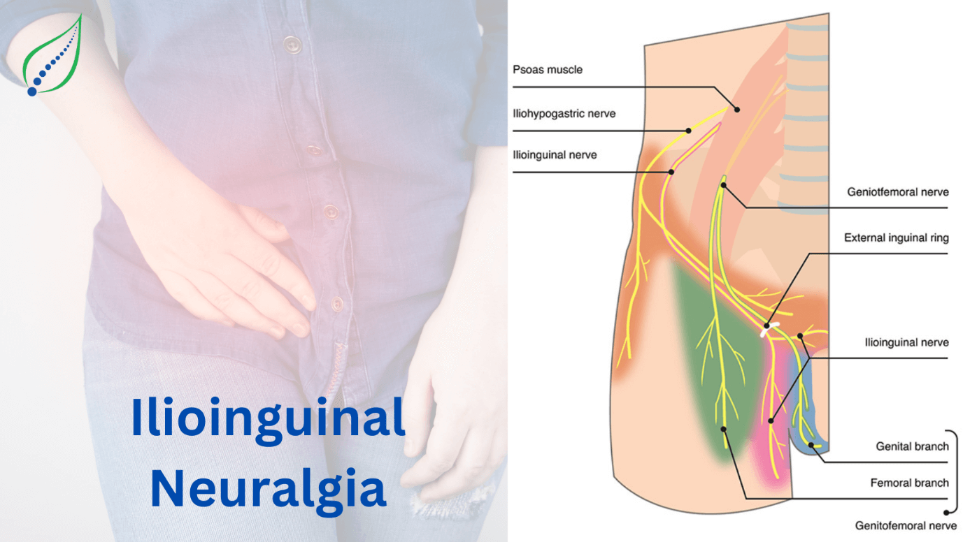 ilioinguinal-neuralgia