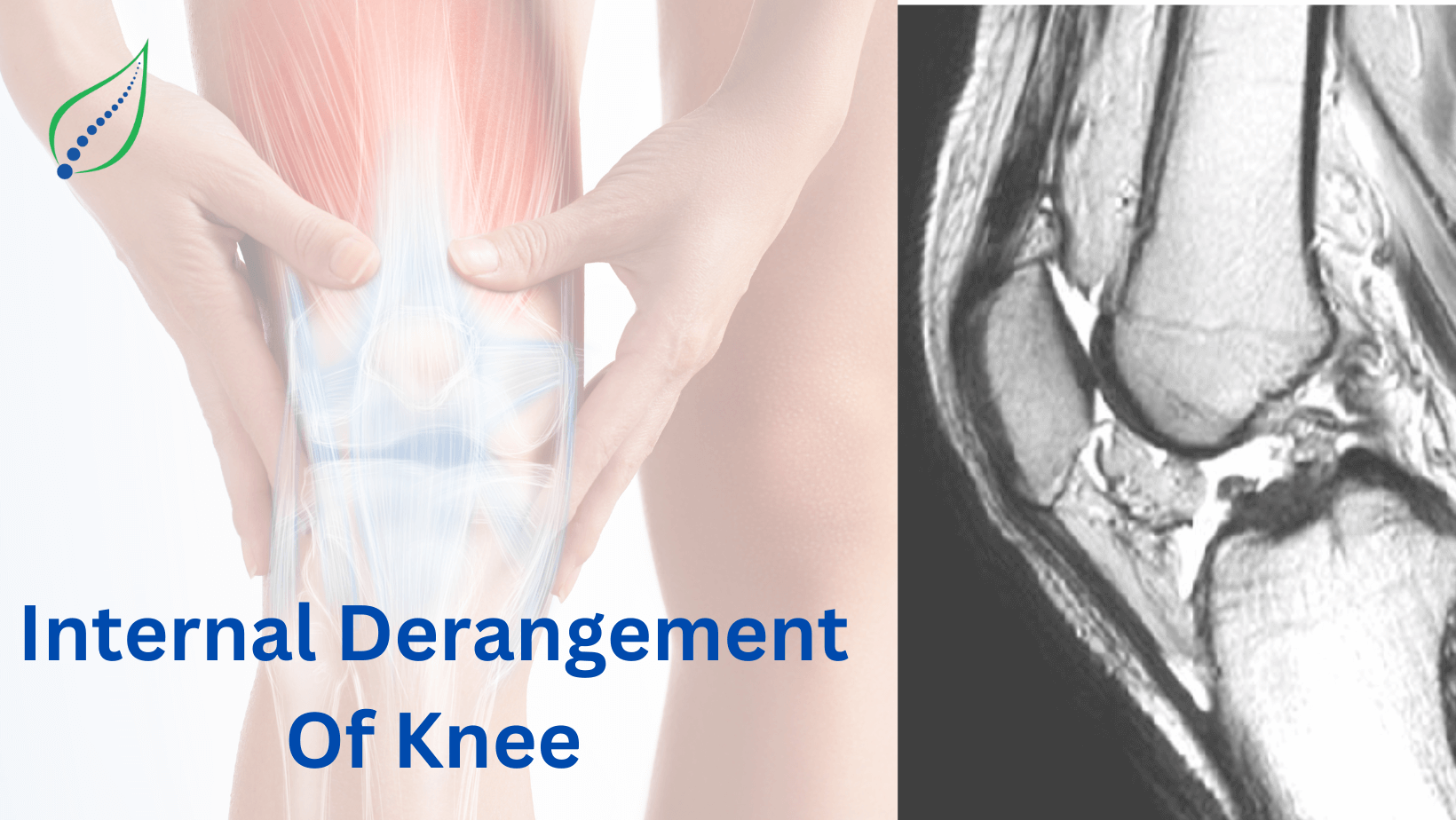 Internal Derangement Of Knee