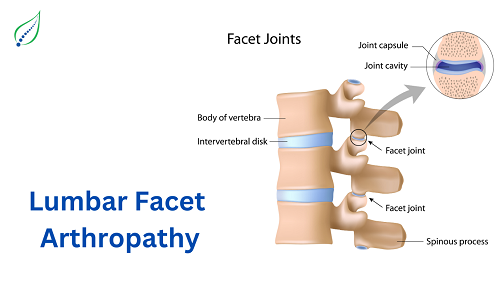 lumbar-facet-arthropathy