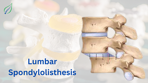 lumbar-spondylolisthesis