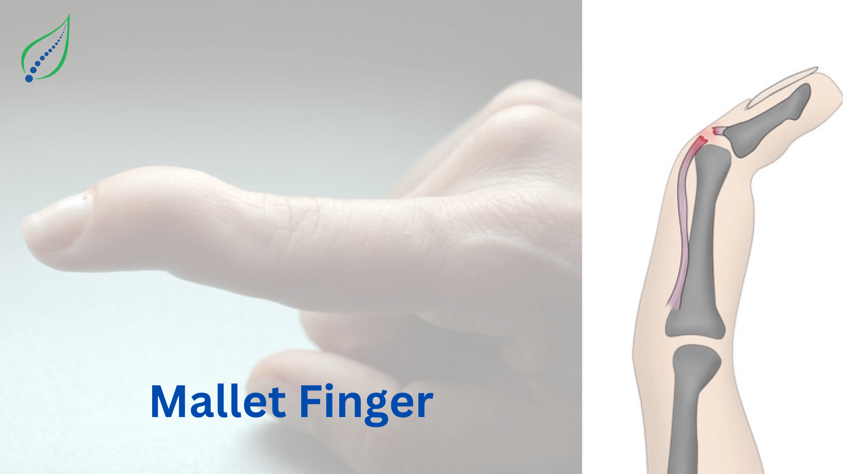 Mallet Finger