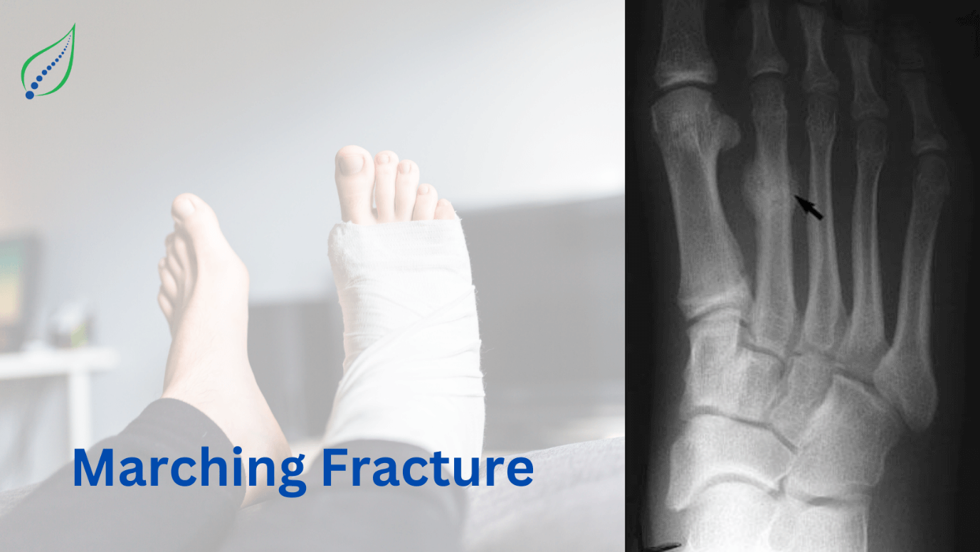 Marching Fracture