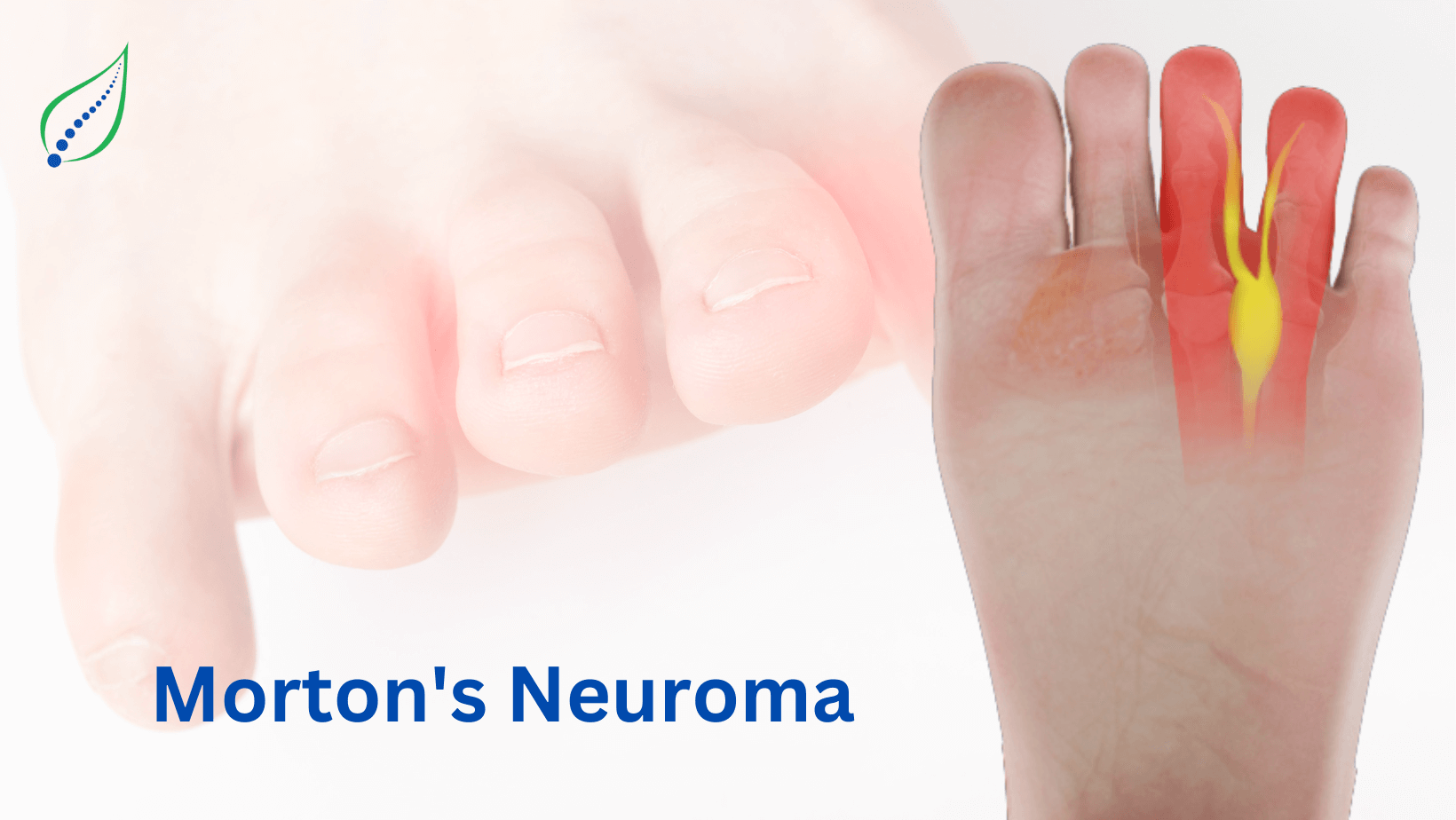 Mortons Neuroma