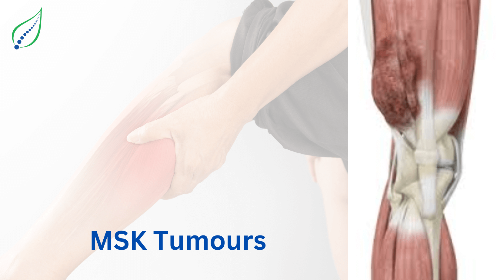 msk-tumours