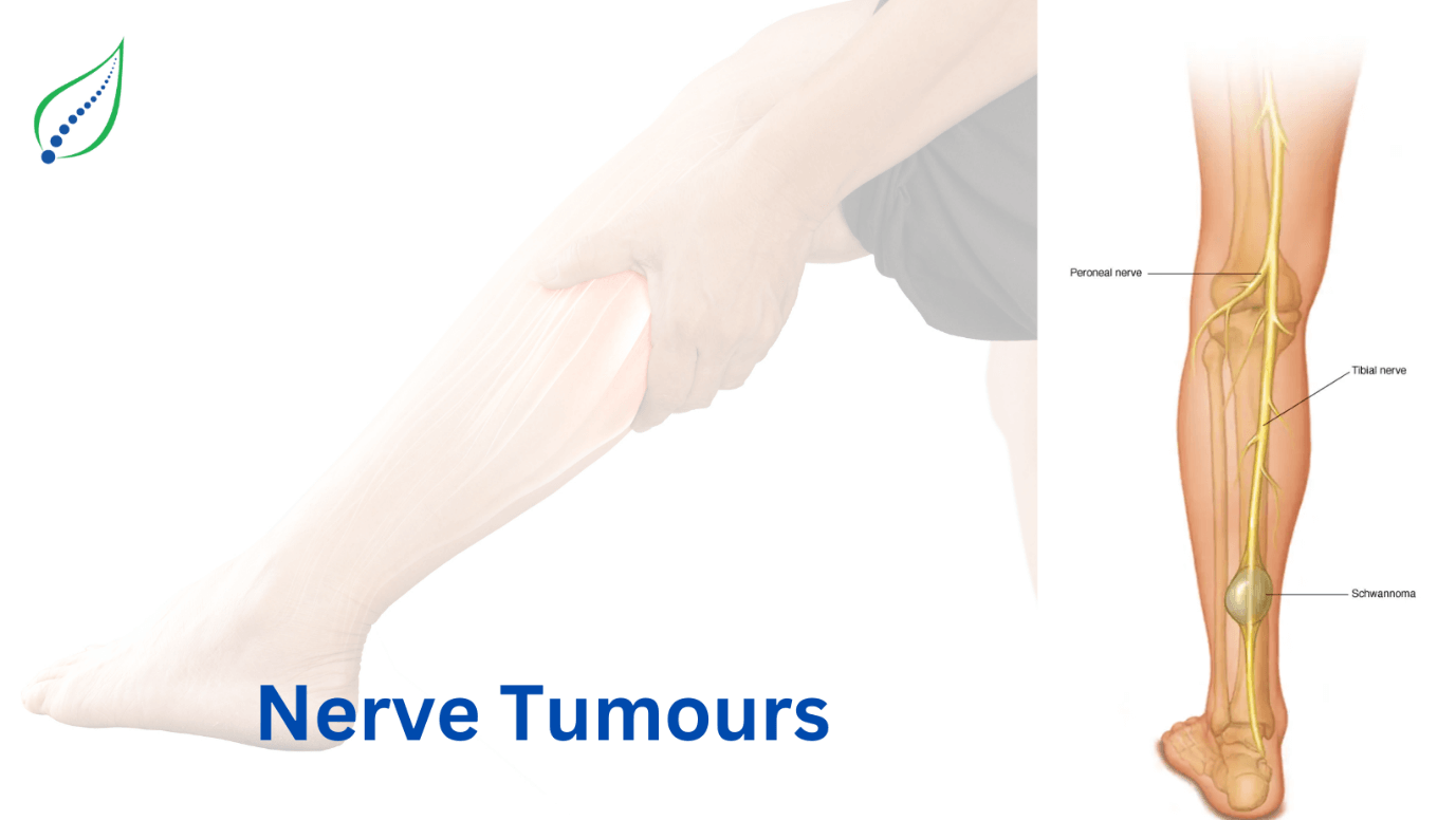 nerve-tumours