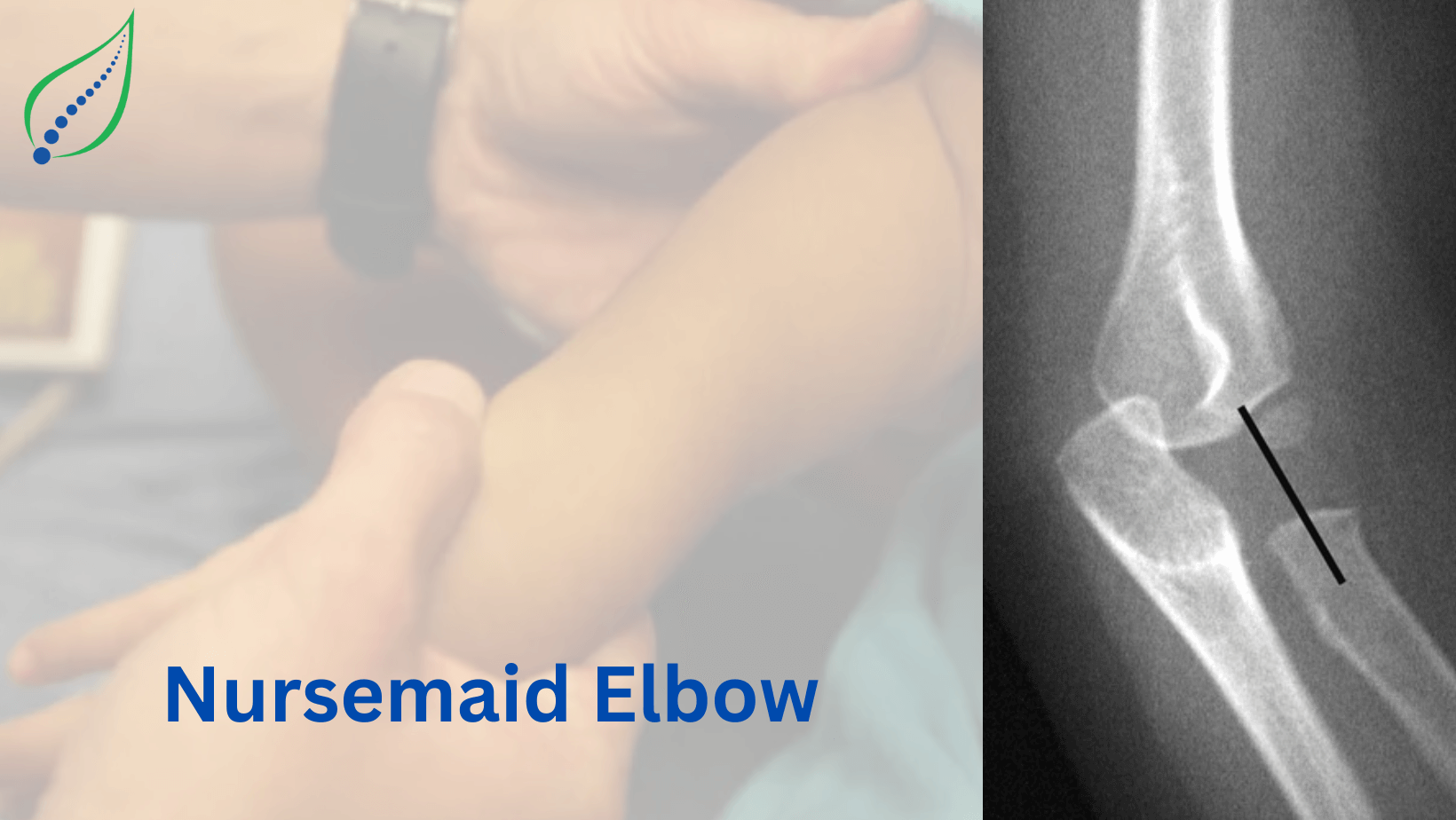 Nursemaid Elbow