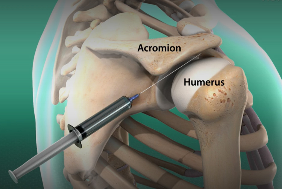 periarticular-injection