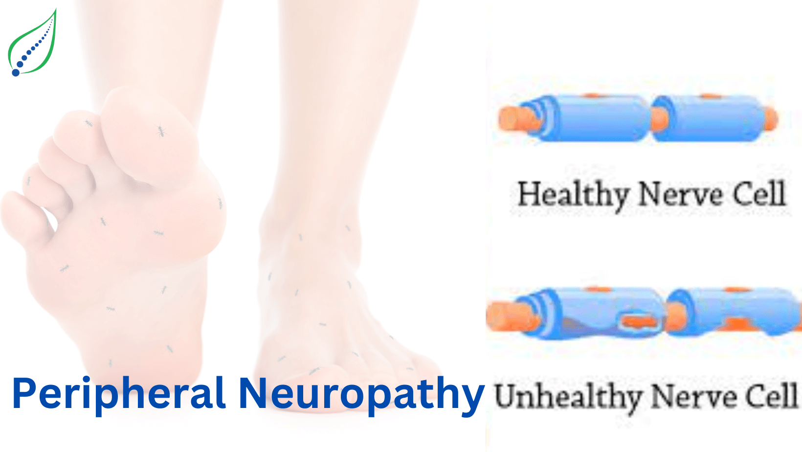 peripheral-neuropathy