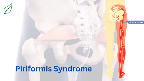 piriformis-syndrome