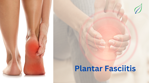 plantar-fasciitis