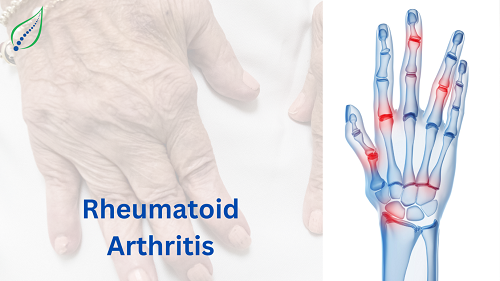 rheumatoid-arthritis