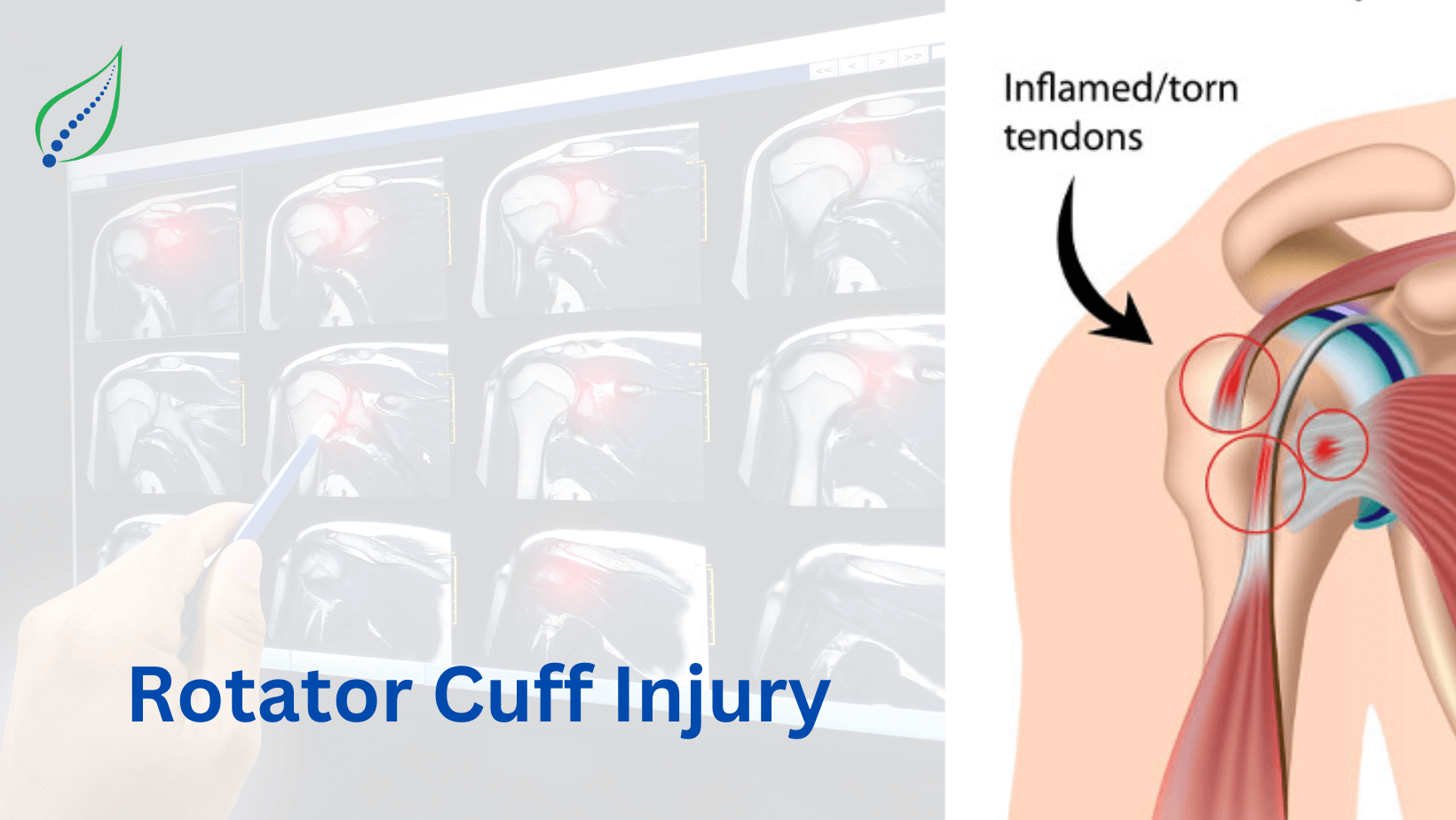 rotator-cuff-injury
