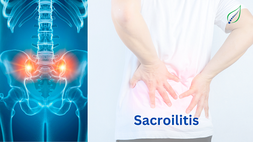 sacroiliitis