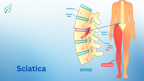 sciatica