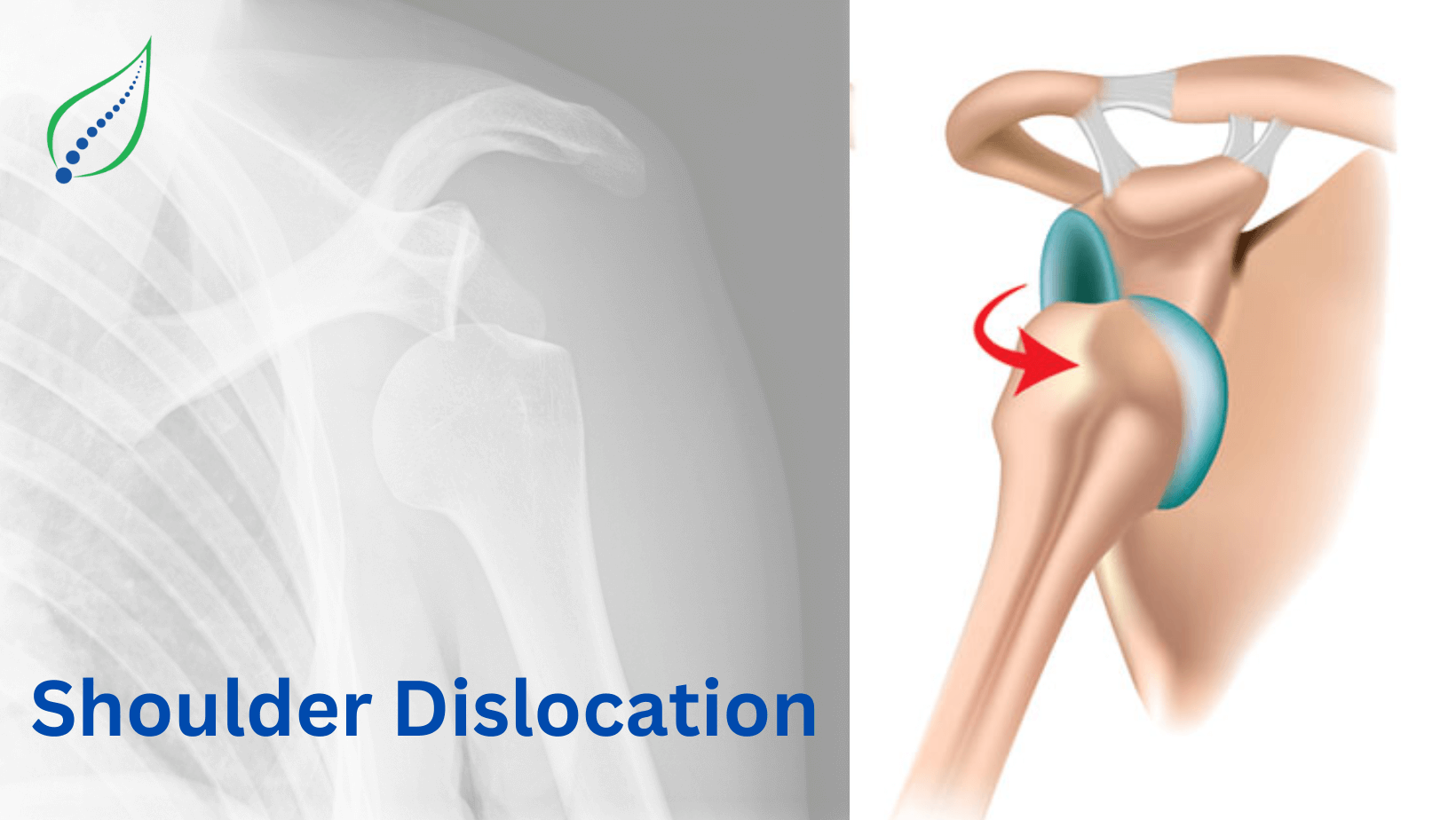 shoulder-dislocation