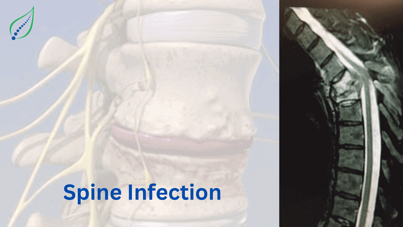 spinal-infection