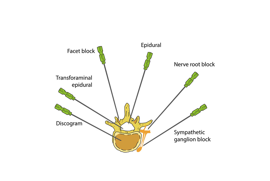 spinal-injection