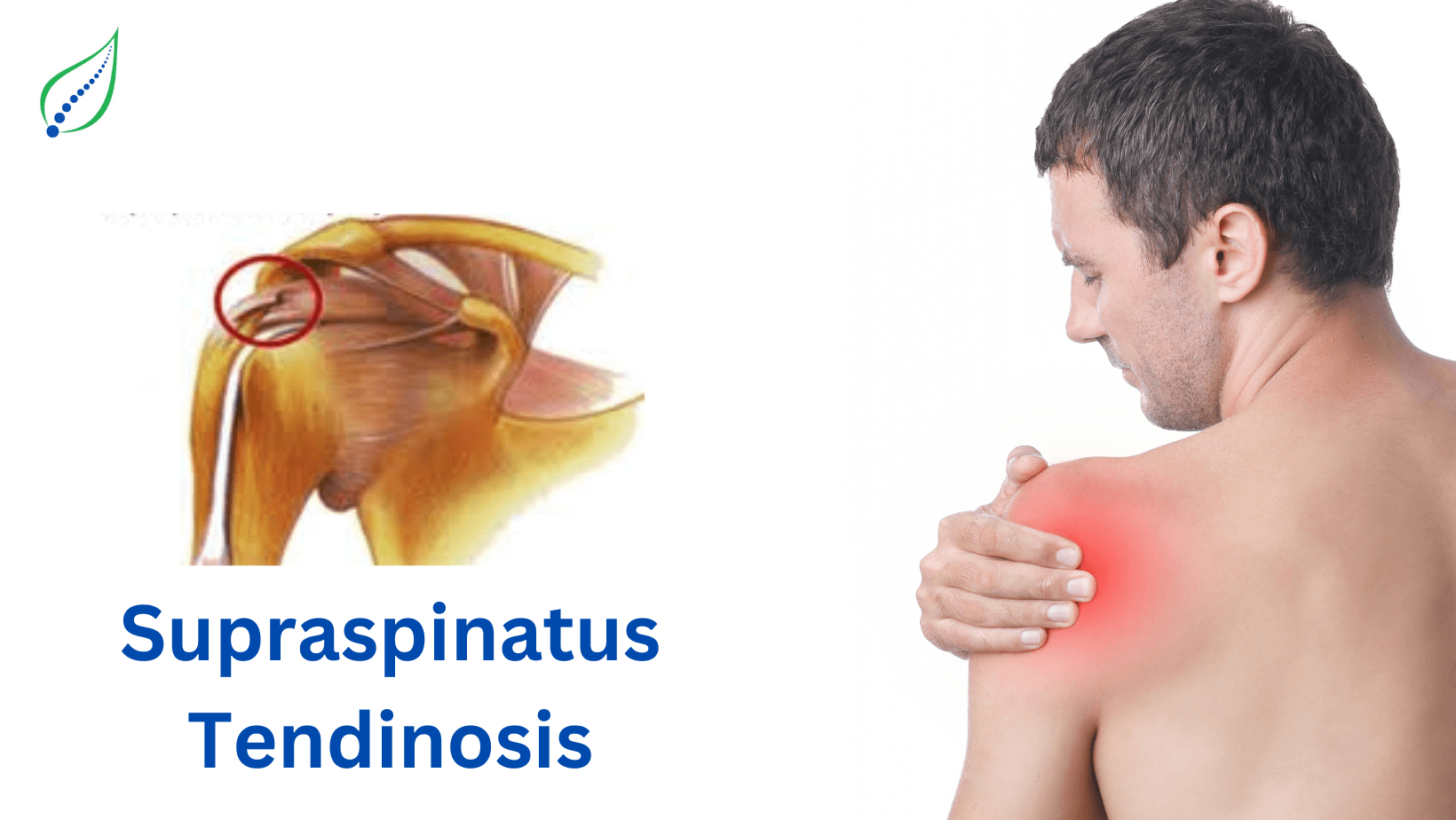 supraspinatus-tendinosis