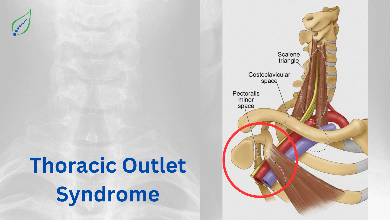 thoracic-outlet-syndrome