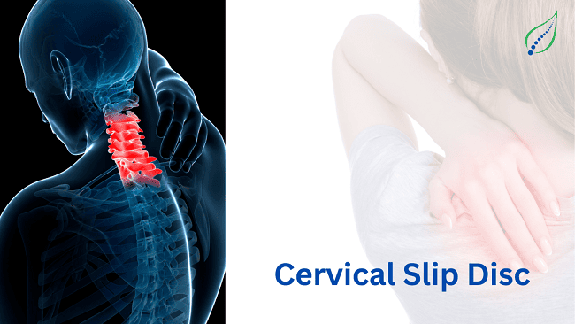 Cervical Slip Disc
