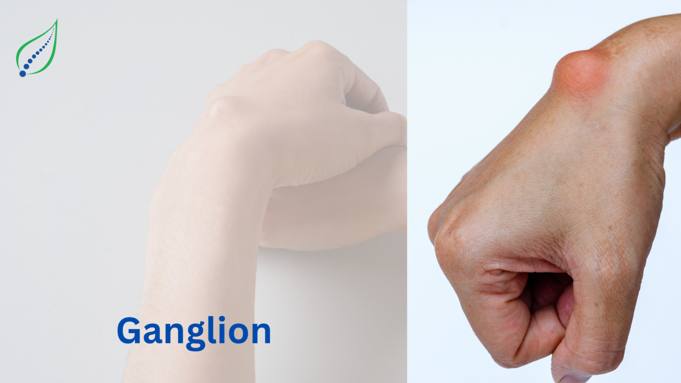 Ganglion Cyst