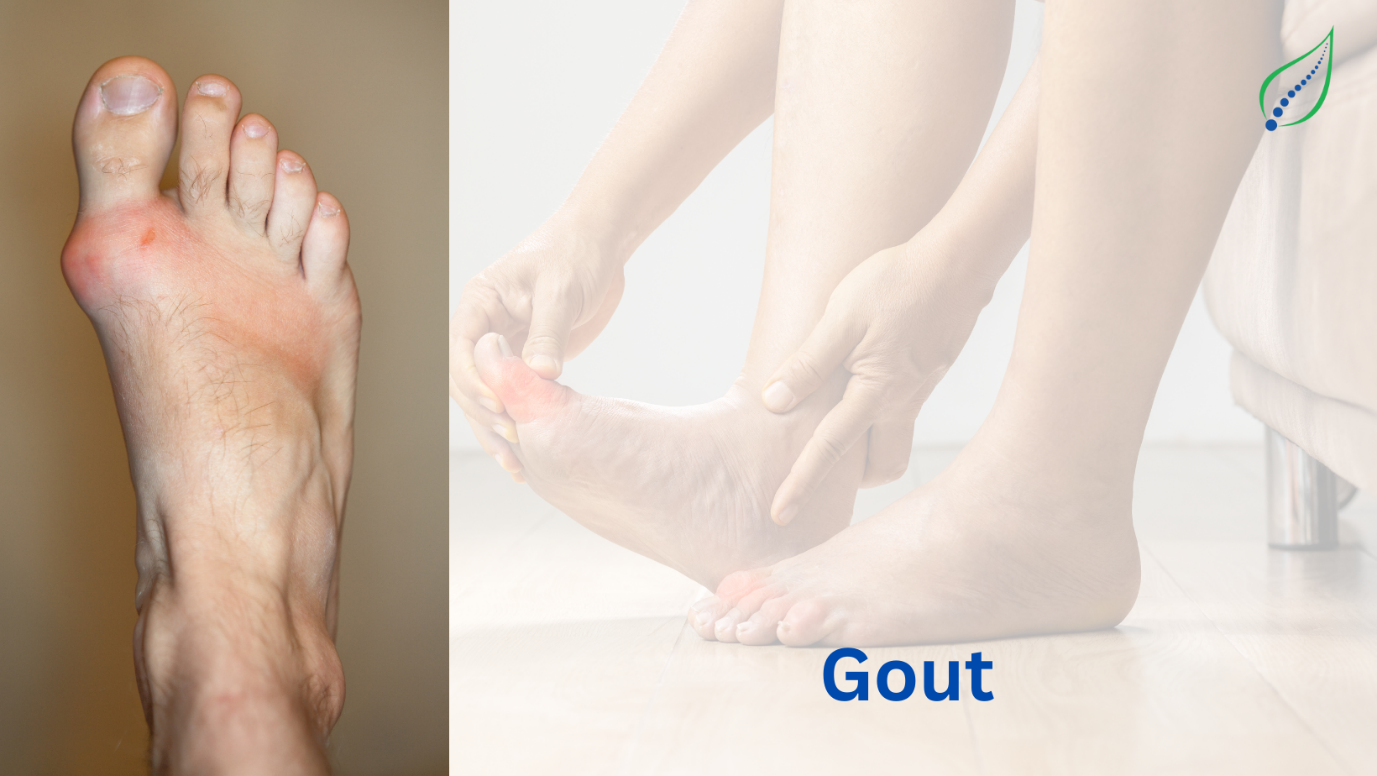 Gout