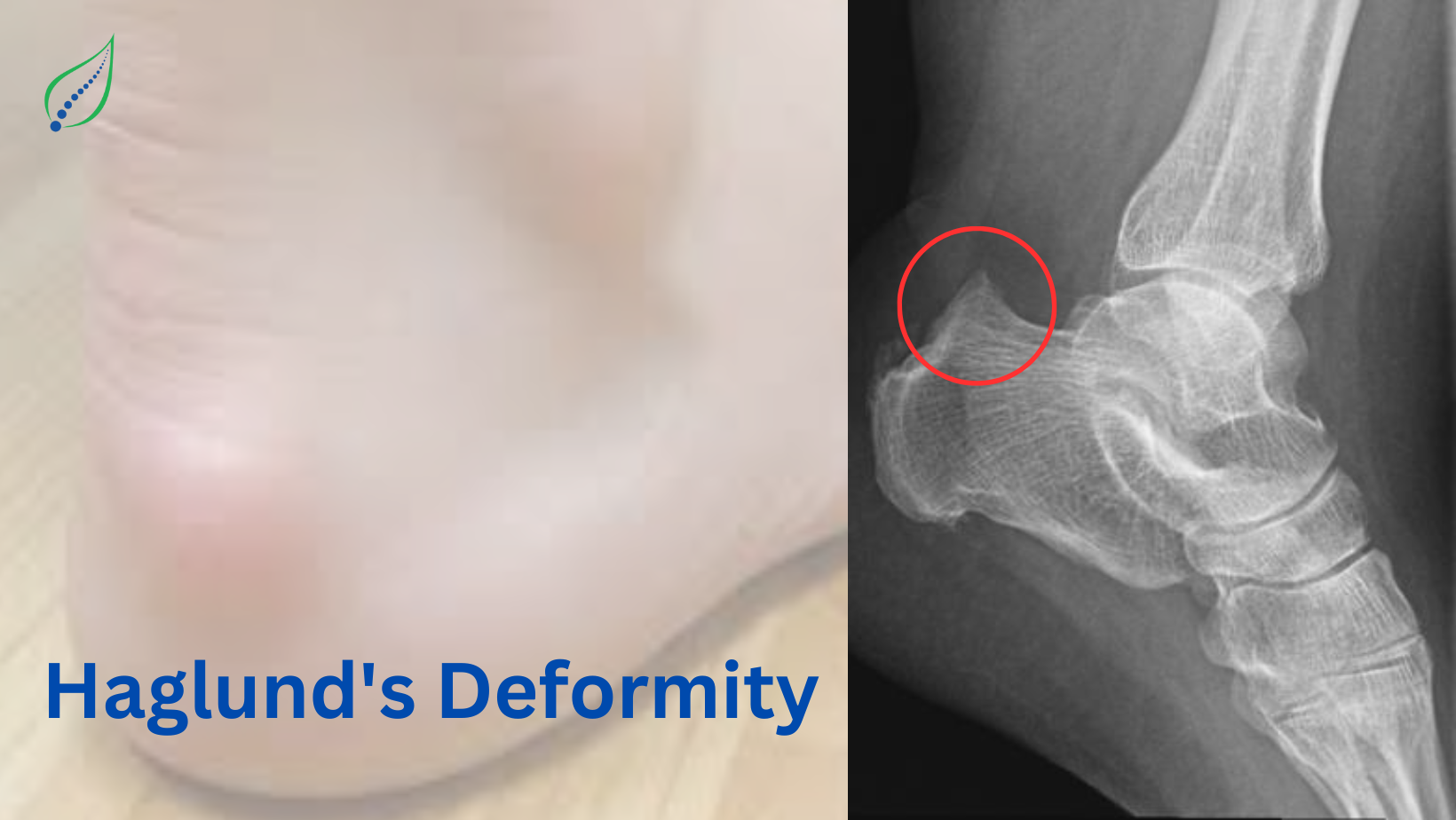 Haglund’s Deformity