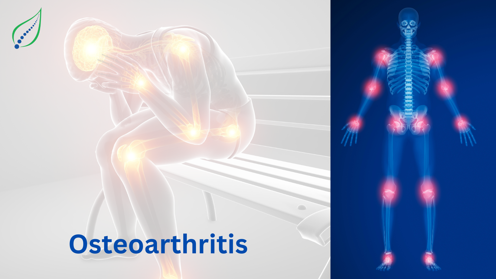 Osteoarthritis