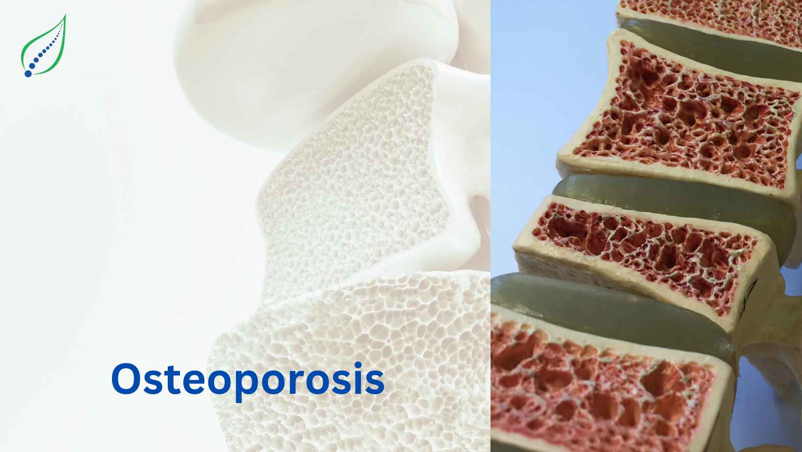 Osteoporosis