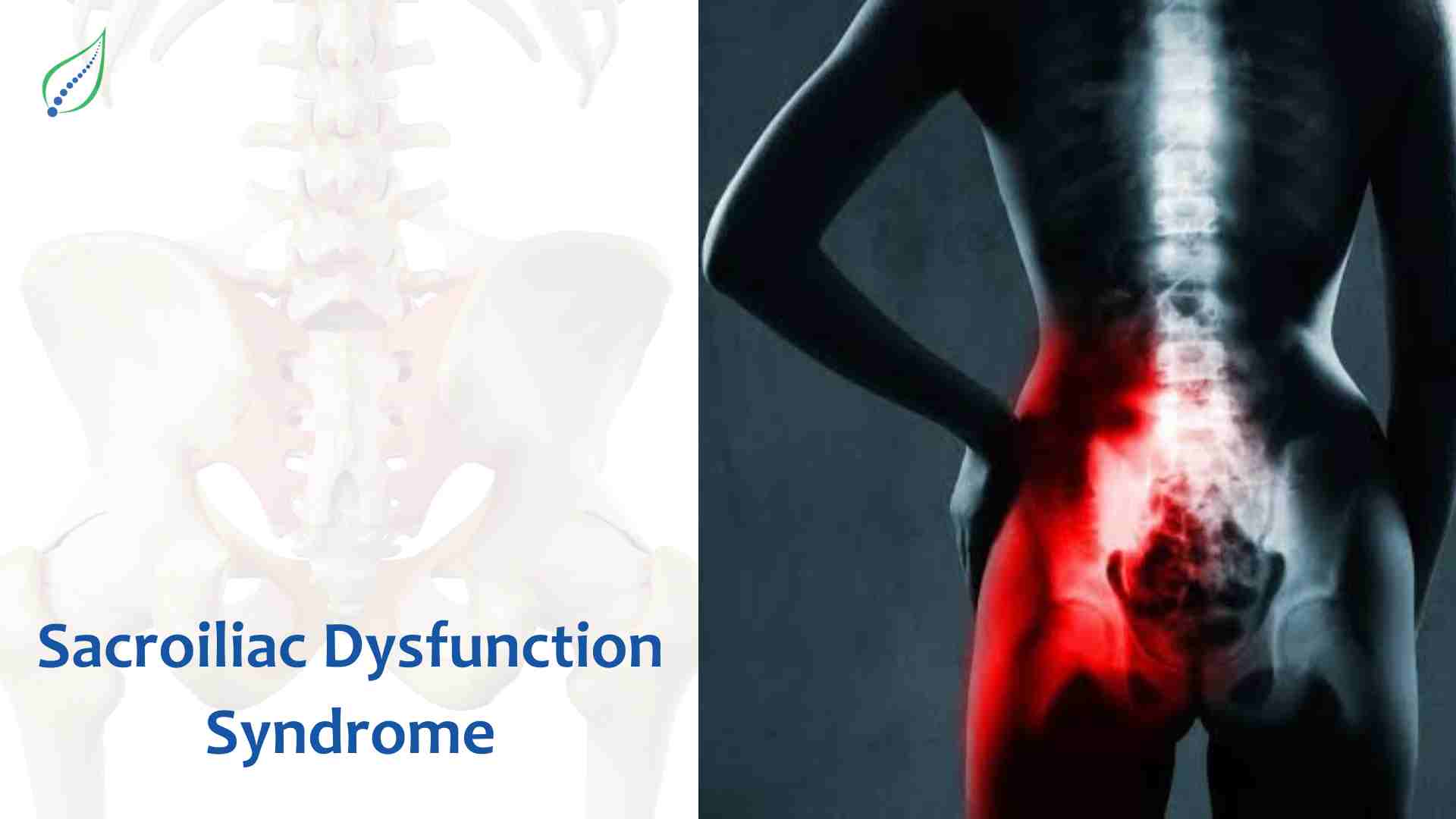 Sacroiliac Dysfunction Syndrome – Causes, Symptoms & Treatment | Best ...