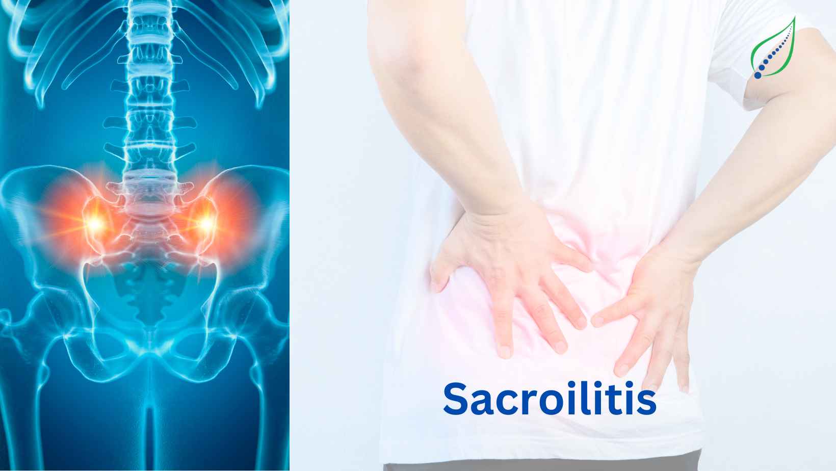 Sacroiliitis