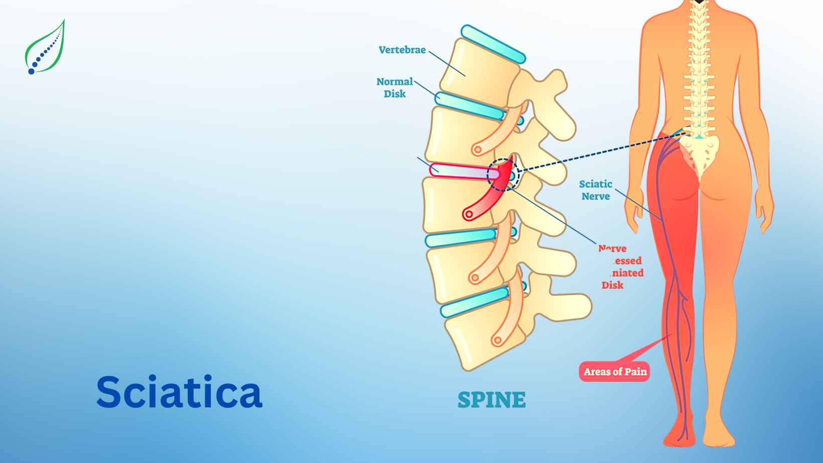 Arthritis vs. Sciatica: Differences in Risk Factors, Symptoms, Treatments