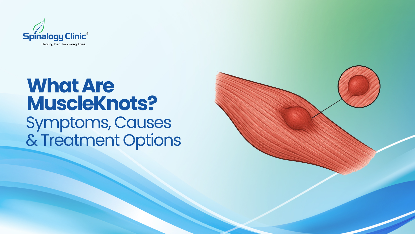 What Are Muscle Knots? Symptoms, Causes & Treatment Options