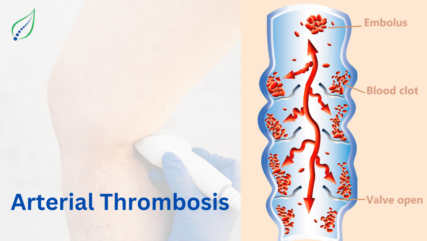 Arterial Thrombosis