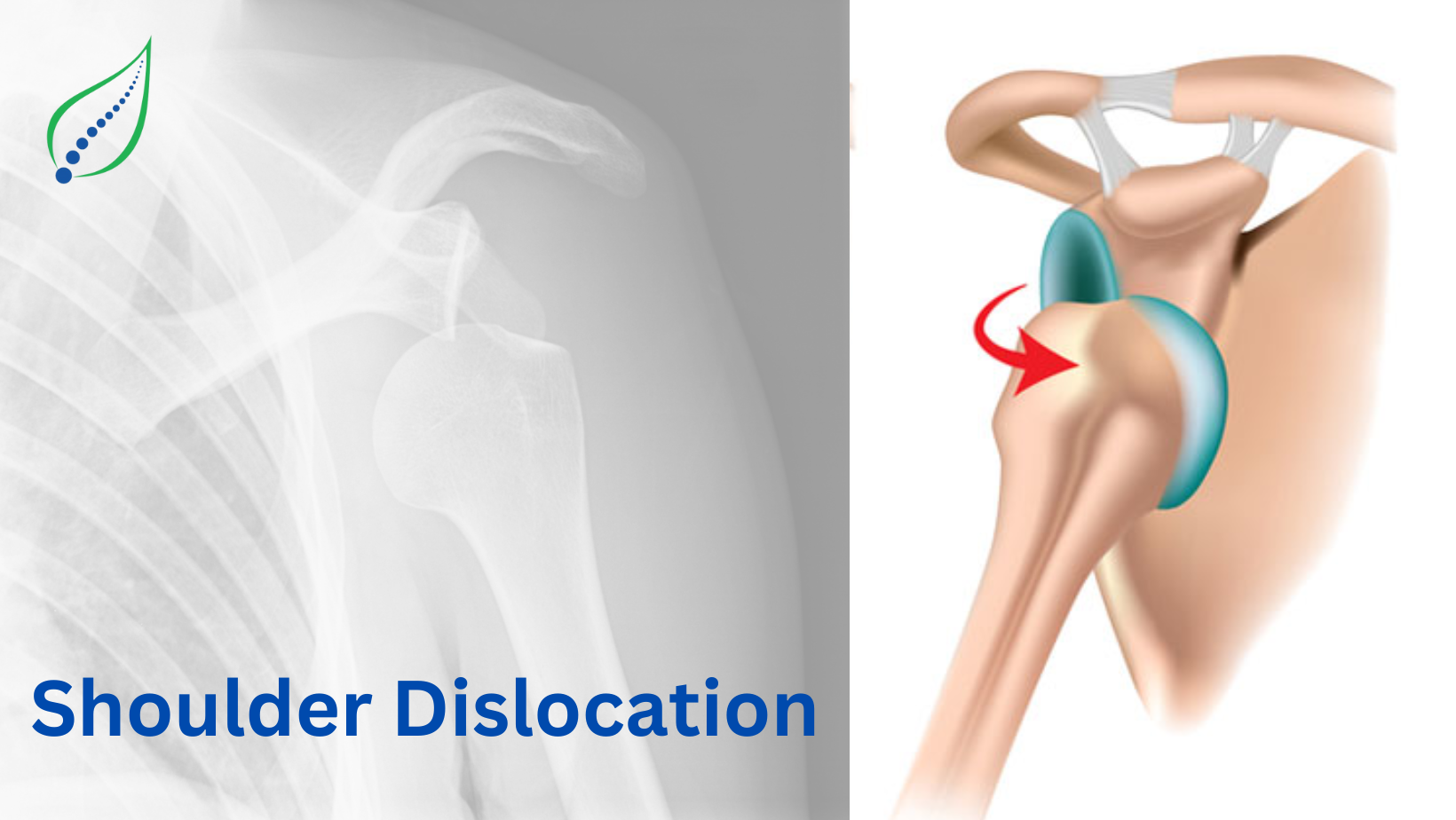 Shoulder Dislocation