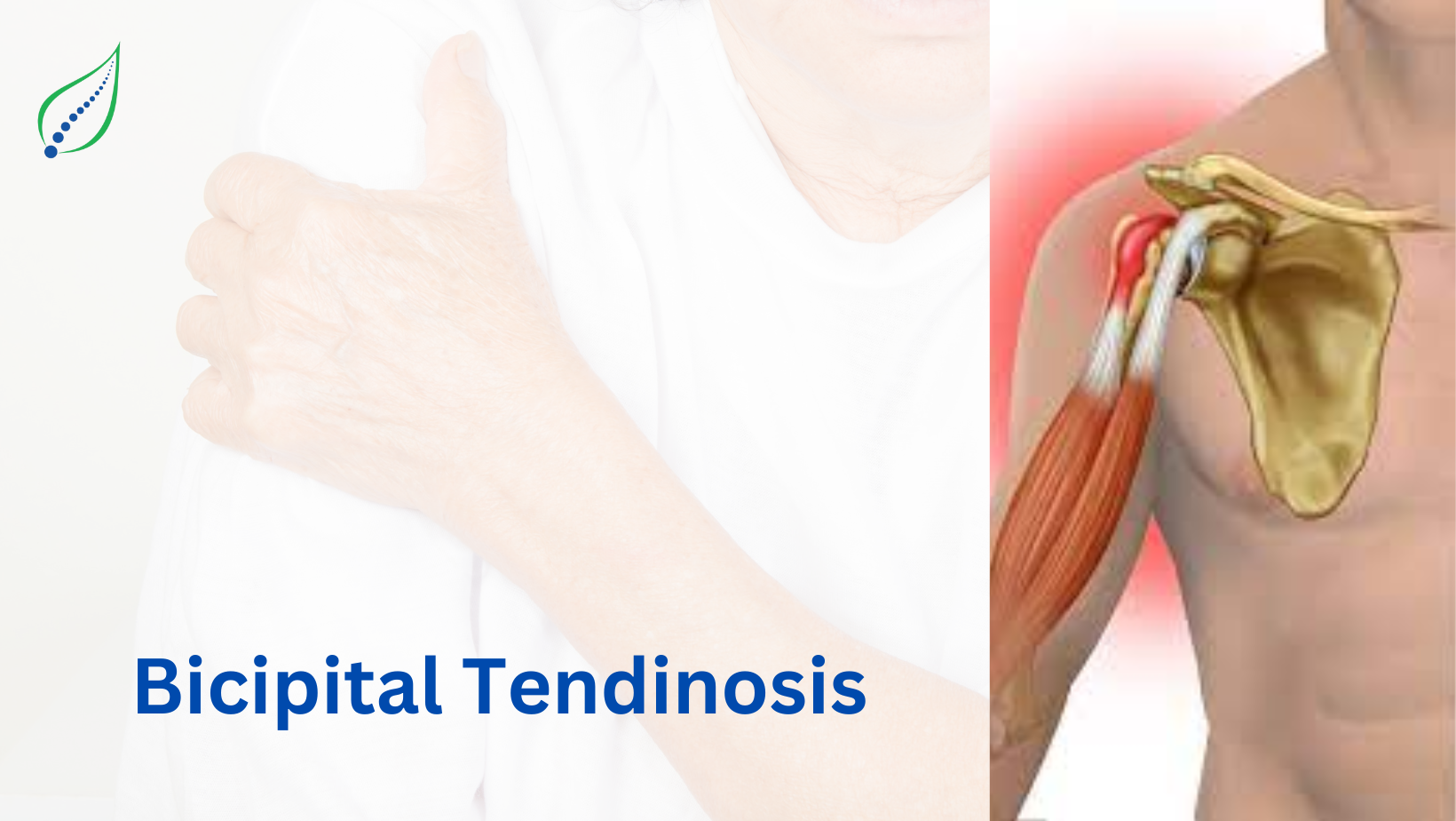 Bicipital Tendinosis