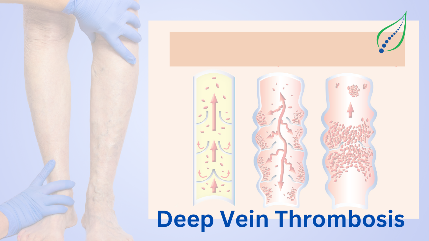 Deep Vein Thrombosis: Symptoms, Causes & Prevention