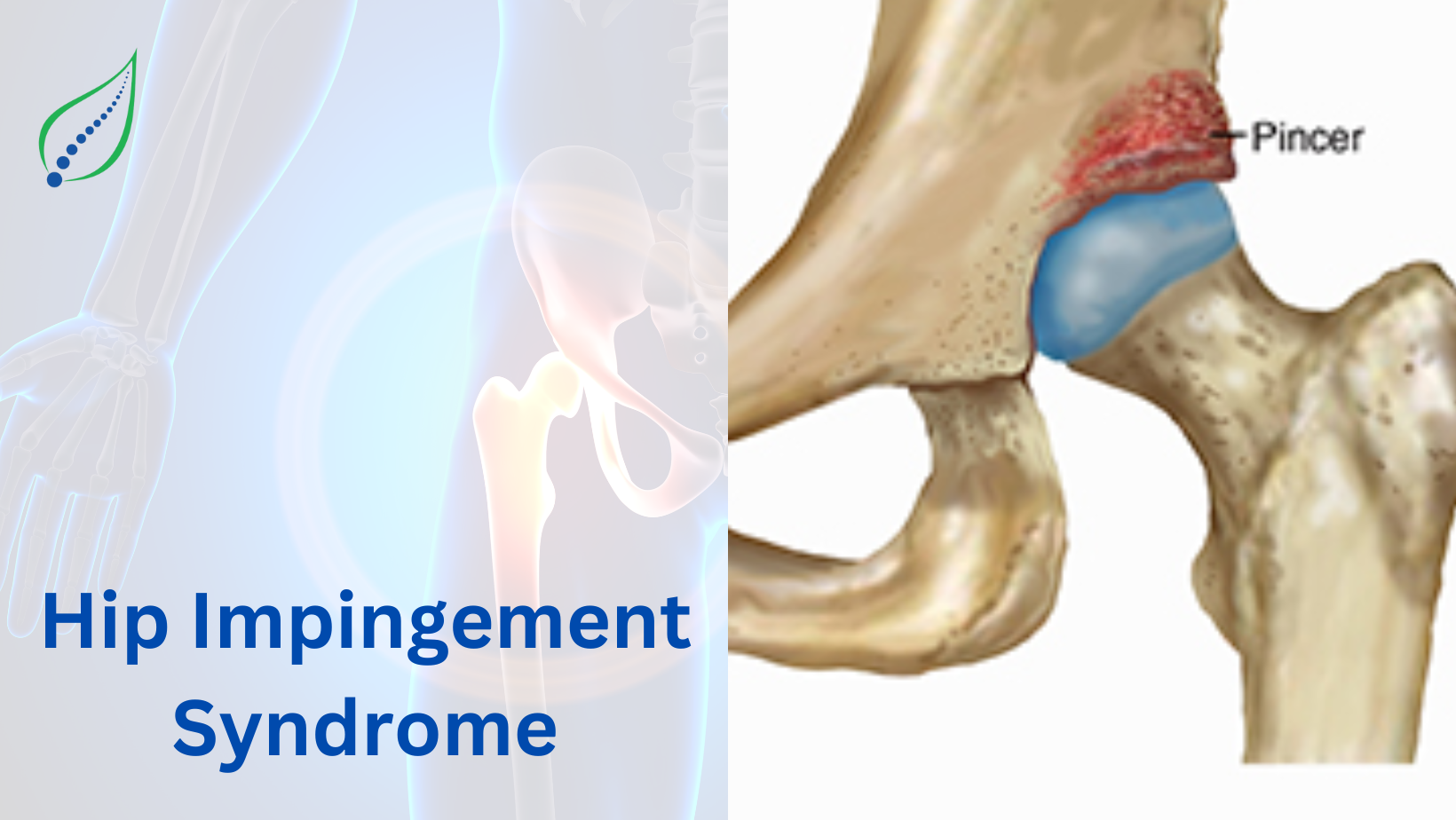 Hip Impingement Syndrome